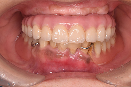 1日で固定式の仮歯まで入る治療