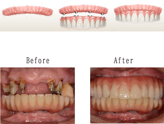 最少4本のインプラントで、全ての歯を支える治療方法